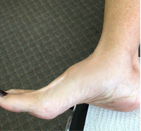 Midfoot osteoarthritis - Treatment options