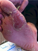 Psoriasis of the Foot