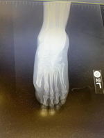 Subluxation of metatarsals following partial amputation in cases of diabetic osteomyelitis
