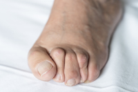 Navigating Hammer Toe: Expert Advice from Podiatrists for Relief