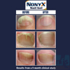 Nonyx® before and after 1