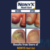 Nonyx® before and after 3