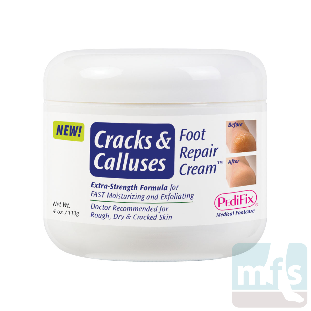 Cracked Heels Cream | Moisturising Foot Cream for Dry Skin | Derma Essentia