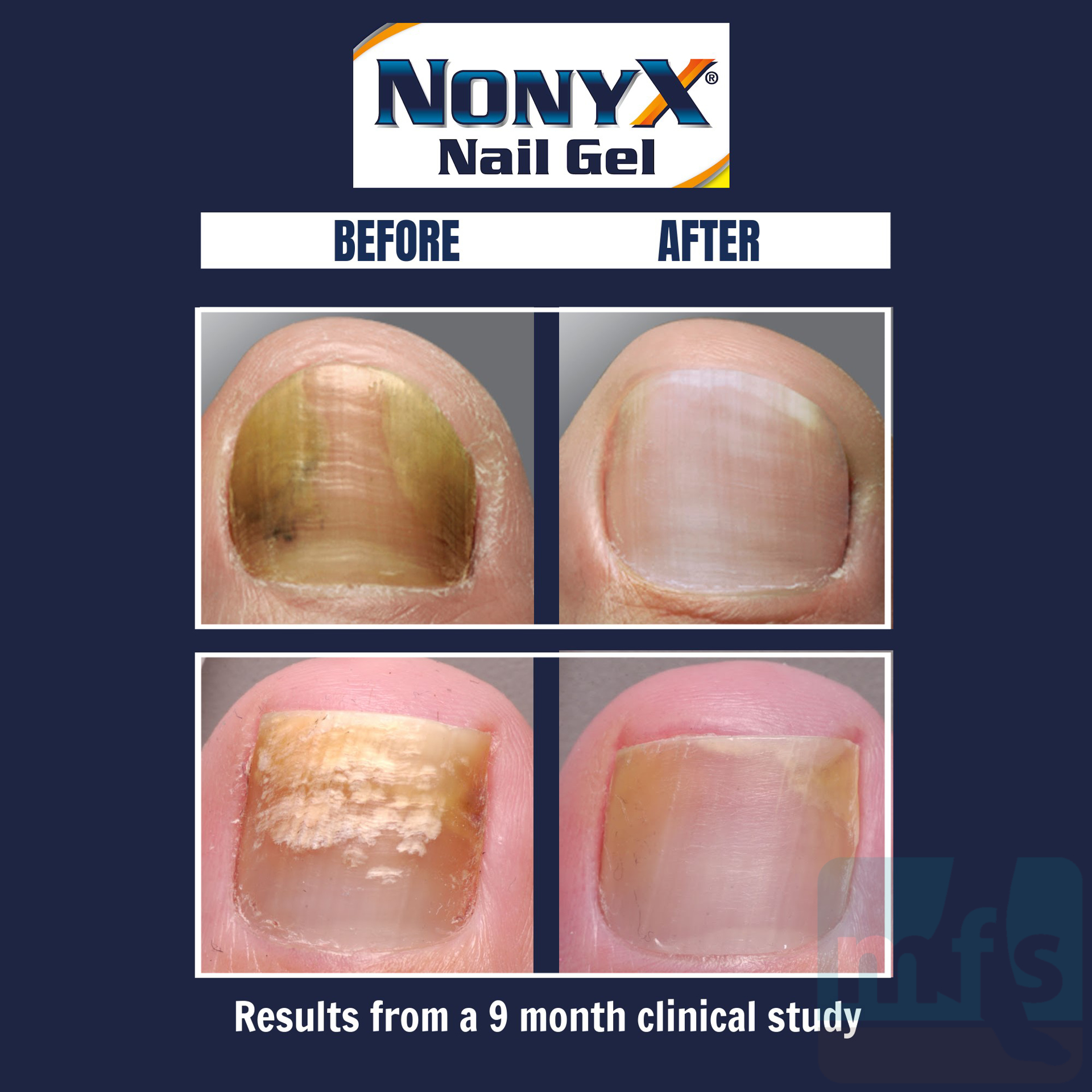 nonyx-fungal-nail-clarifying-gel-subscription-program-myfootshop