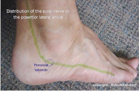 Distribution of the Sural Nerve on the posterior lateral ankle