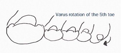 Varus rotation of the 5th Toe (Lister corns)