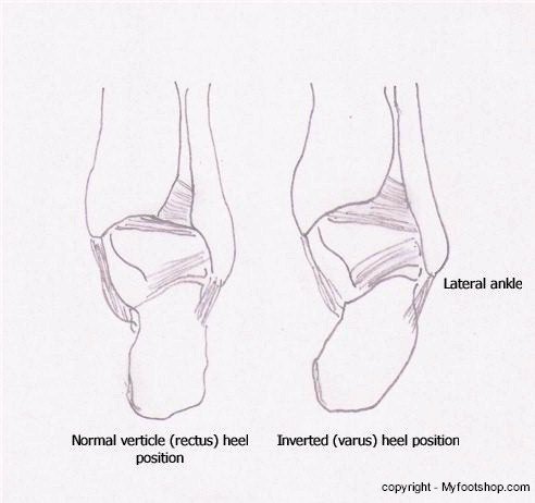 Lateral Ankle Positions - Posterior View