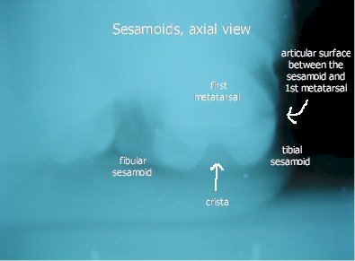 X-ray of the Sesamoids - Axial View