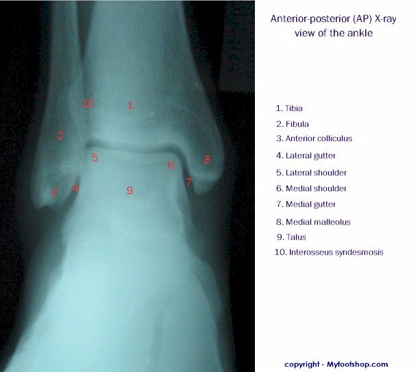 X-ray of the Ankle - Anterior-Posterior View