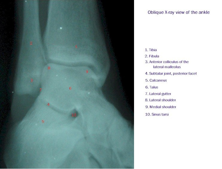 X-ray of the Ankle - Oblique View