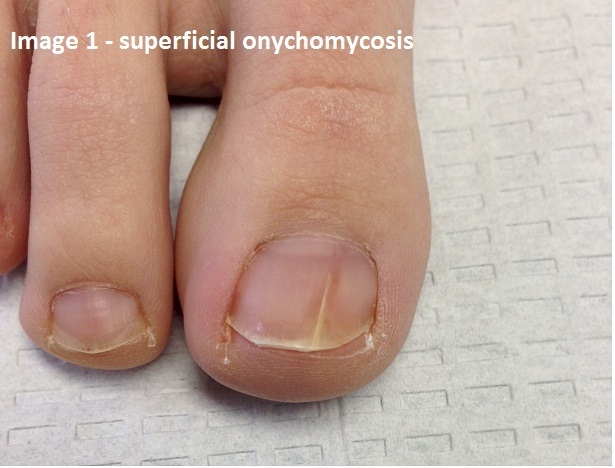 Superficial onychomycosis