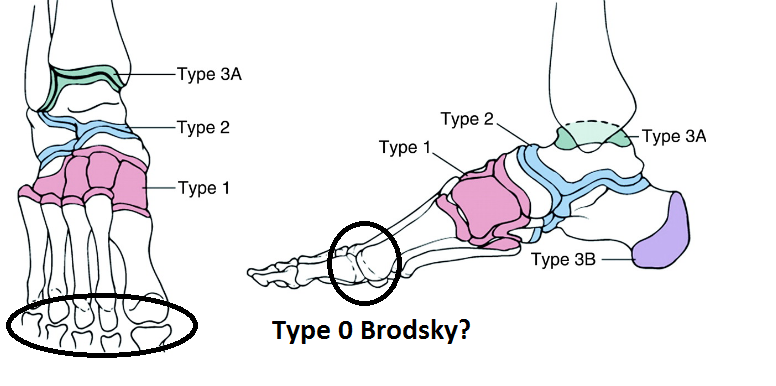 Brodsky classification of neuropathic arthropathy