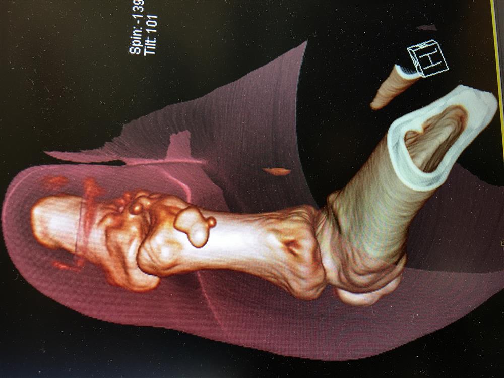 3D reformation mallet toe fracture 