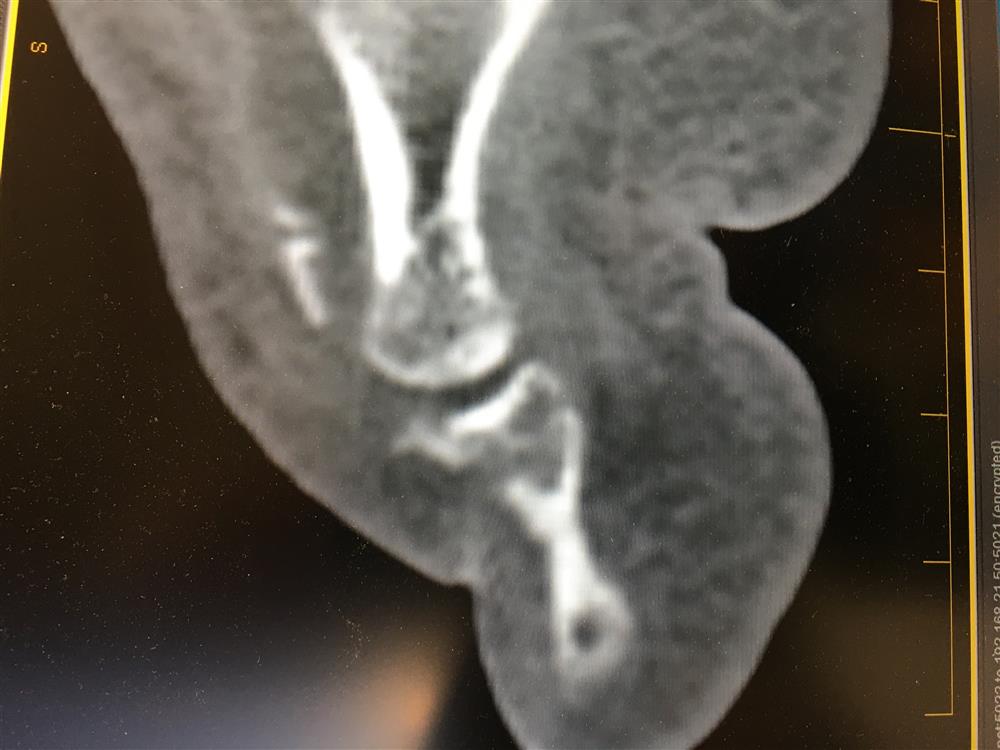 Ct mallet toe fracture