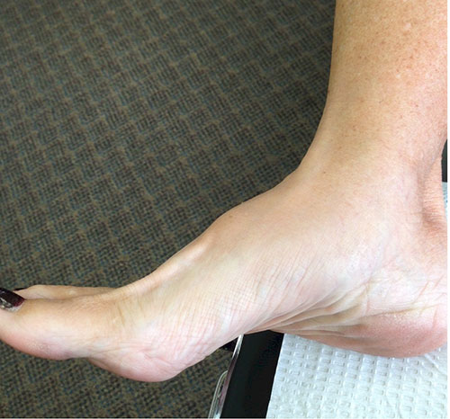 osteoarthritis of the midfoot