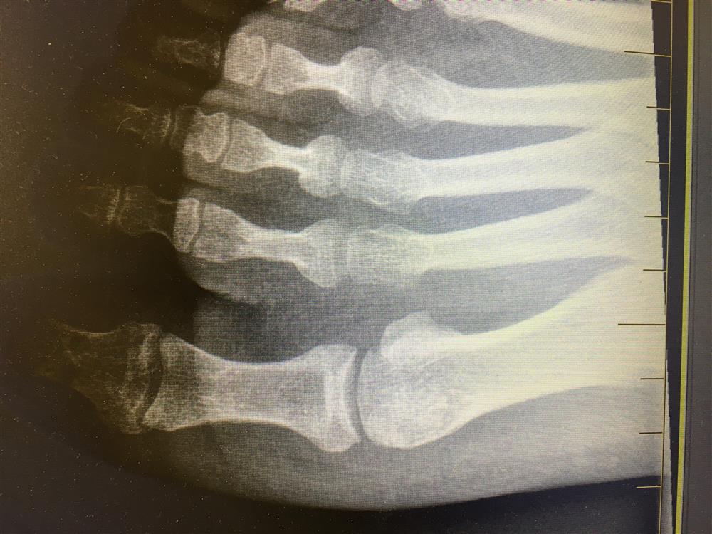 x-ray mallet toe fracture